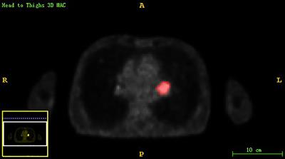 Positron Emission Tomography/Magnetic Resonance Imaging Radiomics in Predicting Lung Adenocarcinoma and Squamous Cell Carcinoma